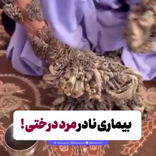 بیماری نادر مرد درختی !